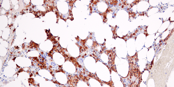 IHC analysis of human multiple myeloma using CRACC/SLAMF7/CD319