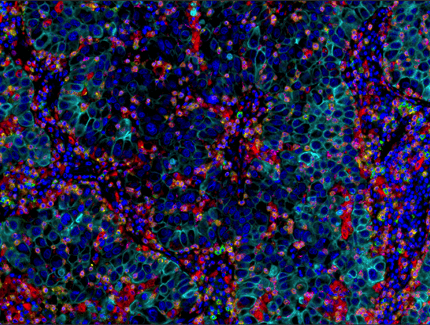 IHC analysis of lung adenocarcinoma using PL-1, CD8a, CD68, LAG3, TIM-3