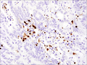 32563_IHC Cleaved-PARP colon cancer