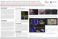 AACR23 poster Spatial resolution of tumor and immune cell  pancreatic ductal adenocarcinoma 200px
