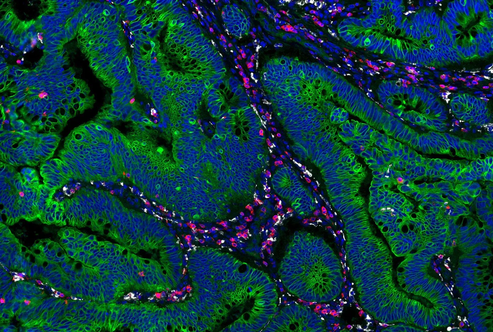 Immunohistochemical analysis of paraffin-embedded human colon adenocarcinoma using Pan-Keratin MultiMab® Feline Chimeric Monoclonal Antibody mix #52203, CD3 epsilon (D7A6E) Mouse Chimeric Monoclonal Antibody #30099, CD68 (D4B9C) Rabbit Monoclonal Antibody #76437, and DAPI #4083.