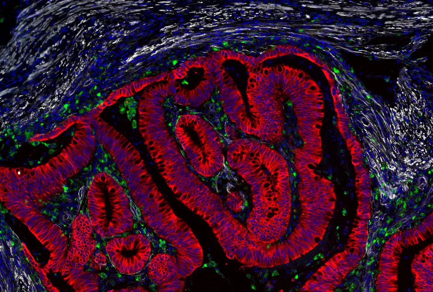 Immunohistochemical analysis of paraffin-embedded human colon adenocarcinoma using Pan-Keratin MultiMab® Rabbit Monoclonal Antibody mix (Alexa Fluor® 647 Conjugate) #34207, CD68 (D4B9C) Rabbit Monoclonal Antibody (Alexa Fluor® 488 Conjugate) #24850, alpha-Smooth Muscle Actin (D4K9N) Rabbit Monoclonal Antibody (Alexa Fluor® 555 Conjugate) #60839, and DAPI #4083.