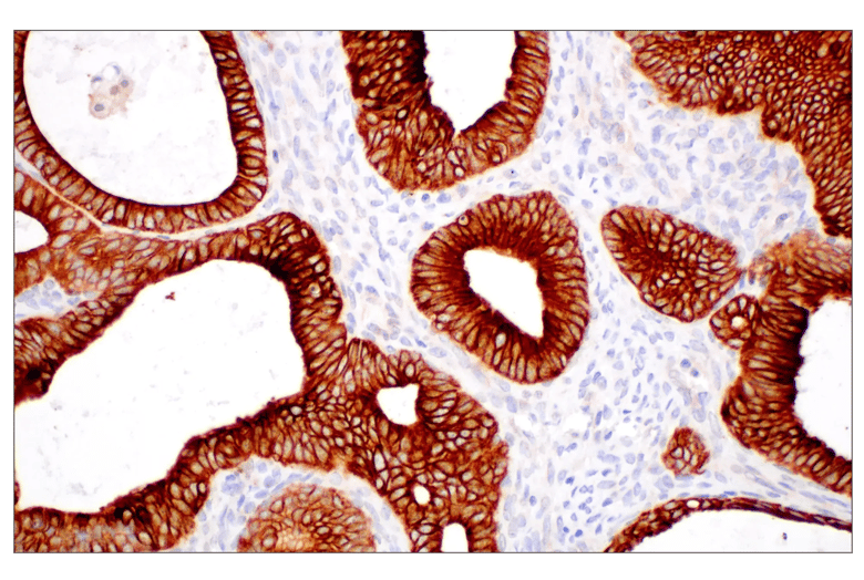 An image of paraffin-embedded human endometrioid adenocarcinoma stained with the Pan-Keratin MultiMab® Rabbit Monoclonal Antibody mix #96963.