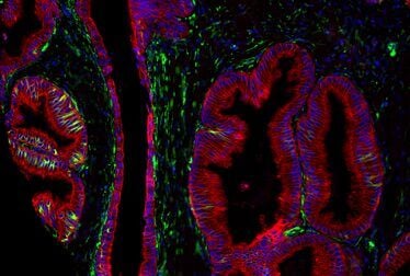 Immunohistochemical analysis of paraffin-embedded human prostate adenocarcinoma using Pan-Keratin MultiMab® Feline Chimeric Monoclonal Antibody mix #52203, Vimentin (D21H3) Mouse Chimeric Monoclonal Antibody #29066, and DAPI #4083.