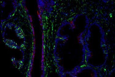 Immunohistochemical analysis of paraffin-embedded human prostate adenocarcinoma using E-Cadherin (D21H3) Rabbit Monoclonal Antibody #3195, Vimentin (D21H3) Mouse Chimeric Monoclonal Antibody #29066, and DAPI #4083.