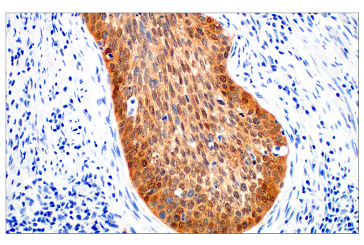 IHC analysis of p16 INK 4A in cervix