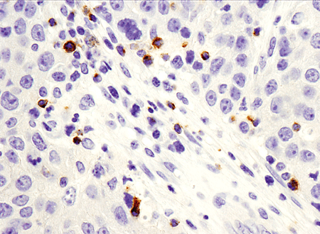 IHC analysis of human breast ductal carcinoma using LAG3