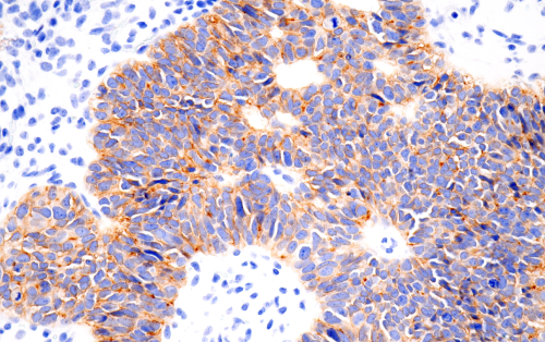 IHC analysis of human serous papillary carcinoma of the ovary using Claudin-6