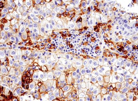 IHC analysis of non-small cell lung carcinoma using PD-L1