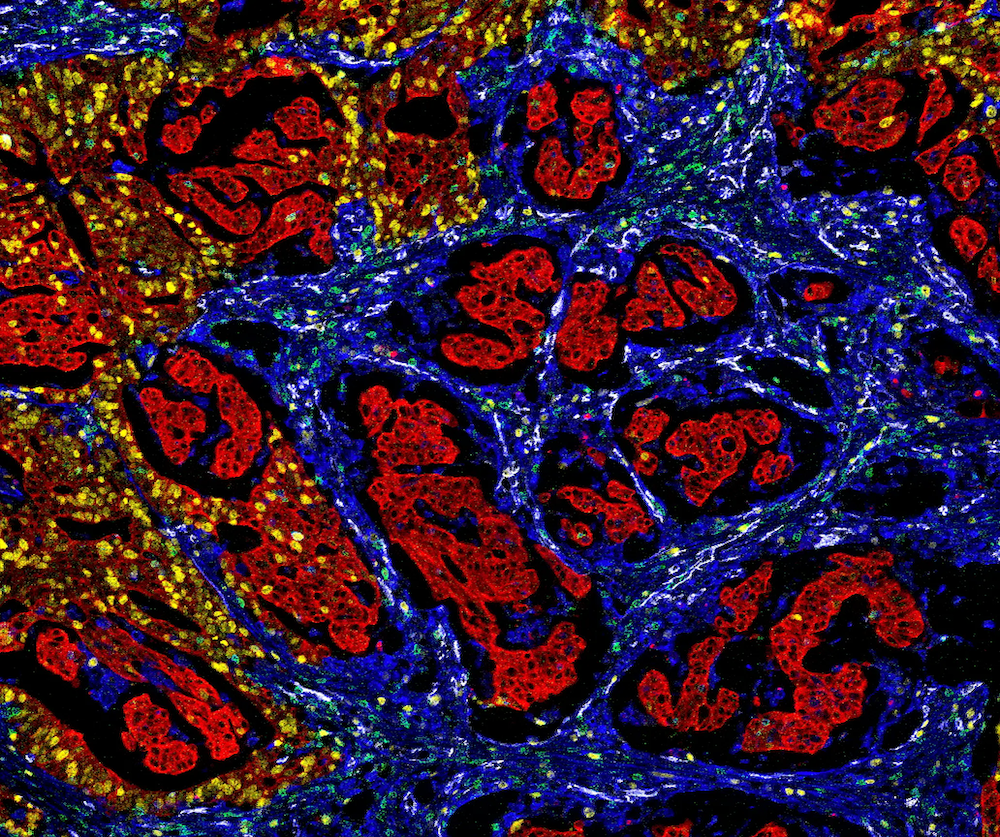 Mass cytometry image of colorectal cancer tissue