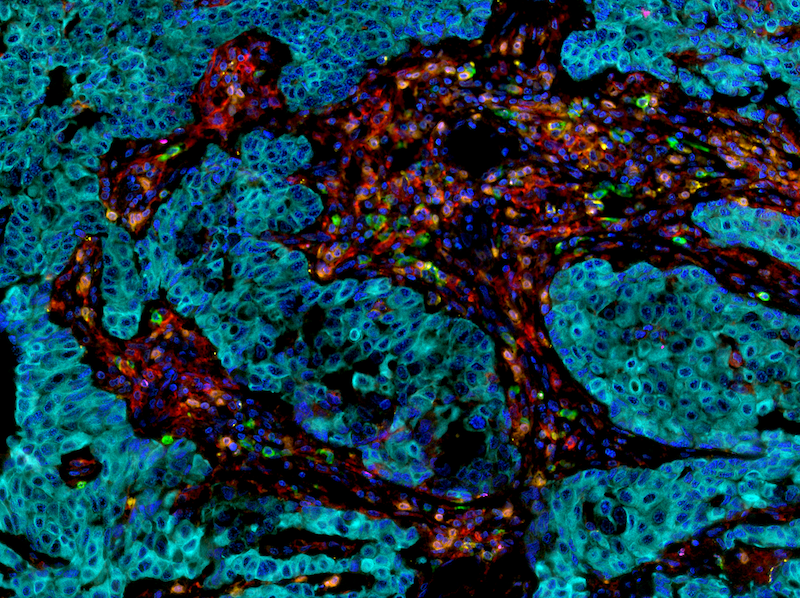 Breast carcinoma tissue probed with a T cell exhaustion antibody panel