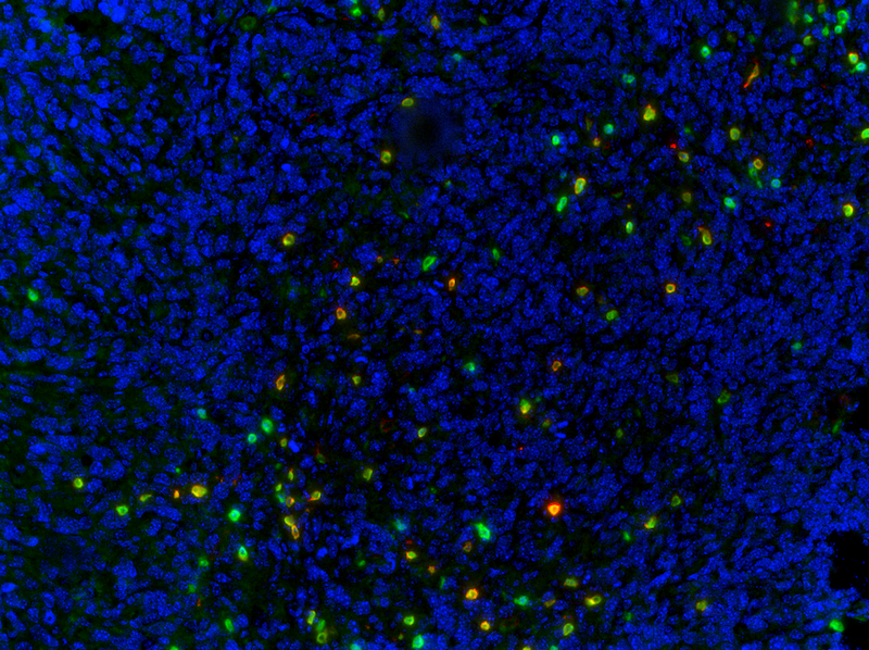 Mouse 4T1 lung metastasis probed with CD3 and CD8