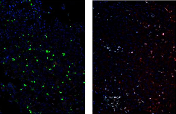 Multiplexed IHC analysis of mouse glioblastoma tumor using PD-1 and CD4