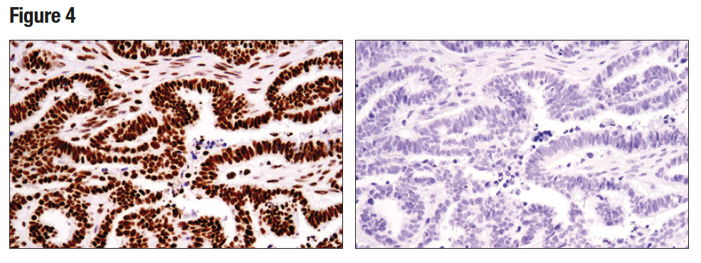 HC analysis of paraffin-embedded human serous papillary carcinoma of the ovary using Tri-Methyl-Histone H3 (Lys36) (D5A7)