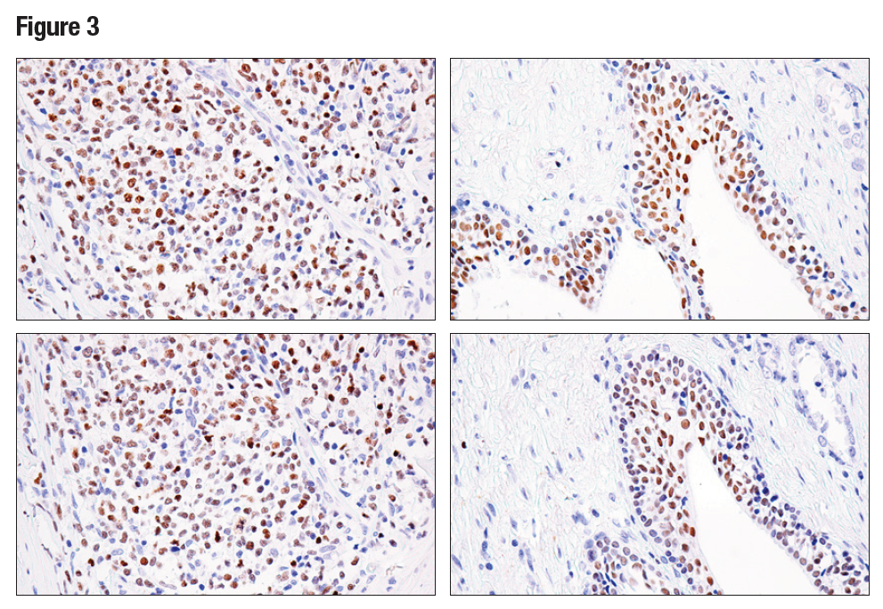 IHC analysis of paraffin-embedded human B-cell non-Hodgkin’s lymphoma (left) or prostate carcinoma (right) using Helios (E4L5U) (upper) or Helios Antibody (lower)