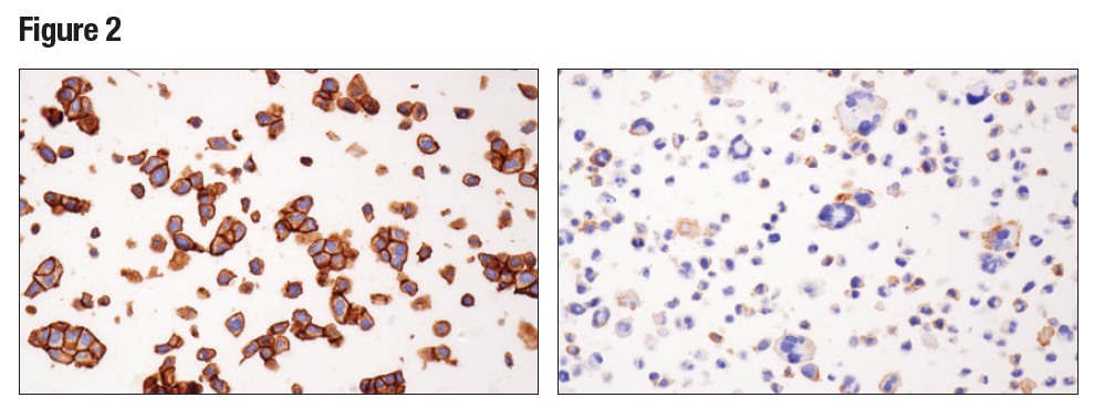 IHC analysis of paraffin-embedded RT4 cell pellet (left) or HDLM-2 cell (right) using Nectin-2/CD112 (D8D3F)