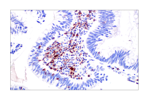 TIGIT positive IHC of human colon adenocarcinoma.