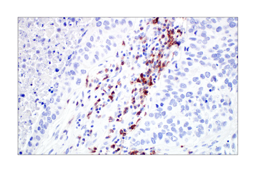 TIGIT positive IHC of human non-small cell lung carcinoma.