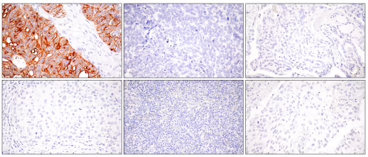 Claudin-6 antibody in cancerous FFPE tissue