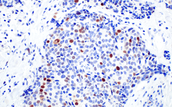 CST50799_IHC_breast cancer_BRCA1 antibody