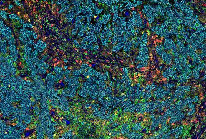 SignalStar multiplex IHC analysis of multiple proteins in human gastric adenocarcinoma performed on the Leica BOND RX