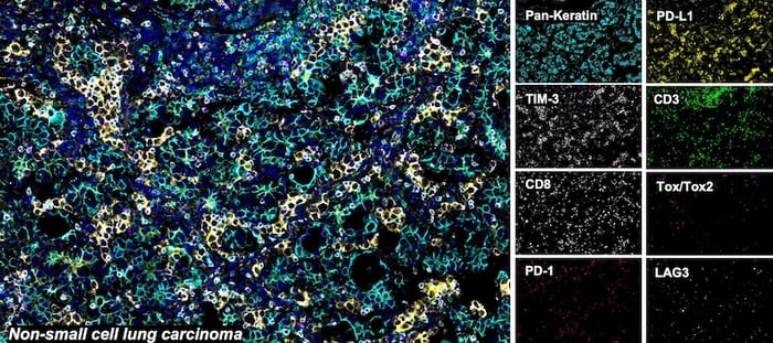 SignalStar™ multiplex immunohistochemical analysis of paraffin-embedded human non-small cell lung carcinoma