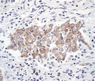 IHC analysis of paraffin-embedded human lung cancer using Bcl-xL antibody.