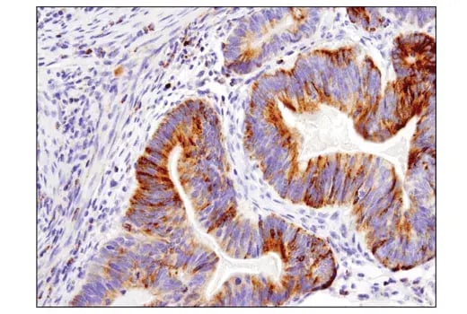 Immunohistochemical analysis of paraffin-embedded human colon adenocarcinoma tissue stained with Bim (C34C5) Rabbit Monoclonal Antibody, showing Bim expression detected using the Leica BOND Rx system.