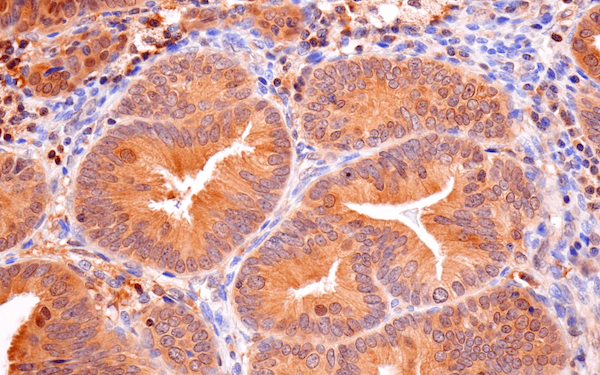 8873_casp8 antibody_uterine cancer_small-1