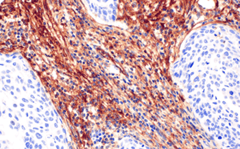 IHC analysis of cervical cancer NT5E CD73 antibody