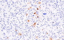 IHC analysis of lung cancer using CLXCL9 antibody