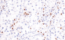 IHC analysis of lung cancer using CCL5/RANTES antibody