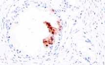 IHC analysis of prostate cancer using CXCL10 antibody