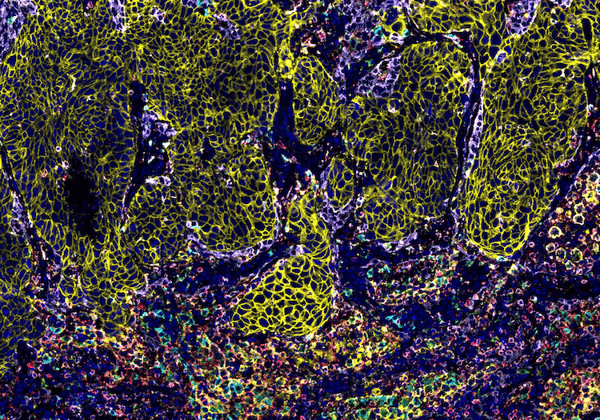 Multiplex IHC analysis of the tumor microenvironment using PD1 and PD-L1 antibody