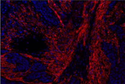 IHC analysis of bladder cancer using FAP antibody