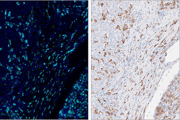 Multiplex IHC analysis of gastric cancer using CD163 antibody