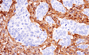 IHC analysis of breast cancer using MHC-i antibody