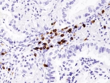 IHC analysis of lung cancer using CD8-alpha antibody