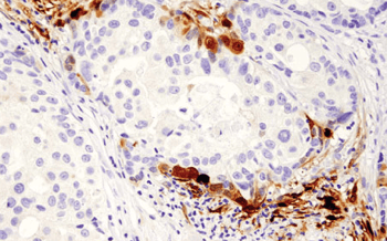 IHC analysis of breast cancer using IDO antibody