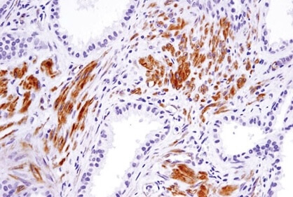 IHC analysis of prostate cancer using SDF1 CXCL12 antibody