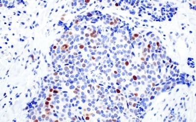 50799_IHC BRCA1 antibody breast cancer PARP inhibitor
