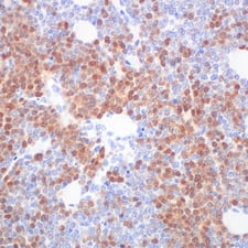 Rad51 84555 IHC A20 syngeneic tumor