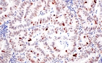 Regulatory protein_IHC MDM2 antibody  endometrioid cancer_82504