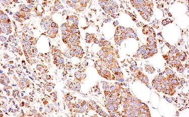 Tumor Glutamine metabolism: IHC analysis of human breast cancer using GLS1 recombinant monoclonal antibody.