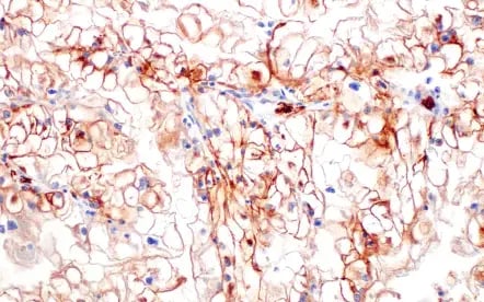 Glucose metabolism: IHC analysis of human renal cell carcinoma using Glut1 recombinant monoclonal antibody.