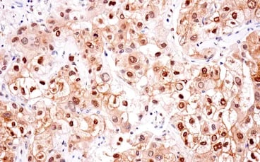 Lipid metabolism: IHC analysis of human hepatocellular cancer using ACLY recombinant monoclonal antibody._IHC ACLY antibody hepatocellular cancer