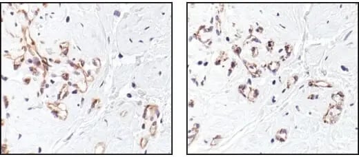 IHC analysis of breast cancer using VEGF Receptor 2 antibody, which can be used to detect VEGFR2  on the surface of endothelial cells in many tumors.