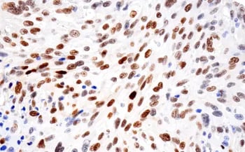 IHC analysis of gastrointestinal stromal tumor using HIF-1α recombinant monoclonal antibody. 