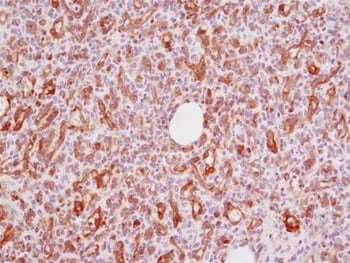 IHC analysis of paraffin-embedded human angiosarcoma using VEGF Receptor 2 antibody