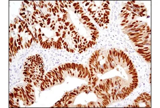 Transdifferentiation: IHC analysis using CDX2 antibody, an intestinal cell marker aberrantly expressed by transdifferentiated columnar epithelial cells during Barrett's esophagus.